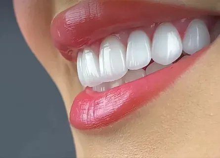 Projekt Hollywood Smile